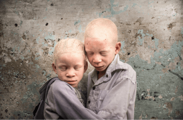 Two young children with albinism embracing each other.
Photo by Patricia Willocq