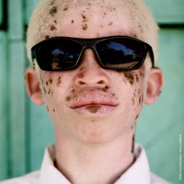Portrait of a young man with albinism.
Photo by Standing Voice / Harry Freeland