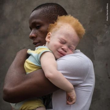 A father embraces his son, who has albinism.
Photo by Patricia Willocq